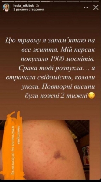 Леся Никитюк показала жуткие травмы, полученные на съемках