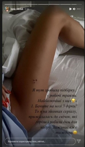 Леся Никитюк показала жуткие травмы, полученные на съемках