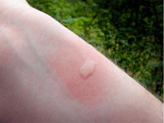 Для початку помийте місце укусу водою з милом: що робити після атаки комарів